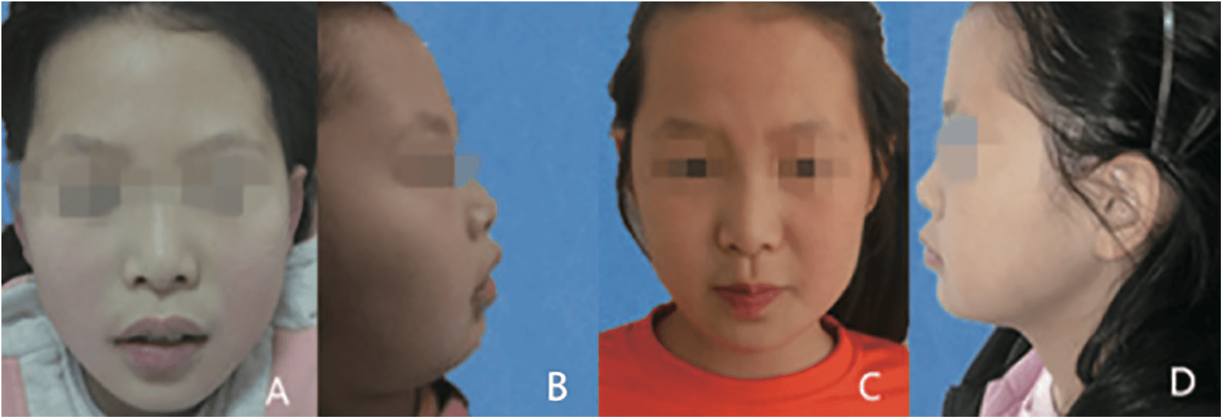 Figure 1. Frontal and lateral facial photographs before and after treatment. (A and B) Before treatment, the patient’s mandible had shrunk back, with a deep overbite facial profile and slight mandibular deviation. (C and D) After treatment, the child’s face was symmetrical, the mandibular retrusion had significantly improved, and the lower third of the face had lengthened.