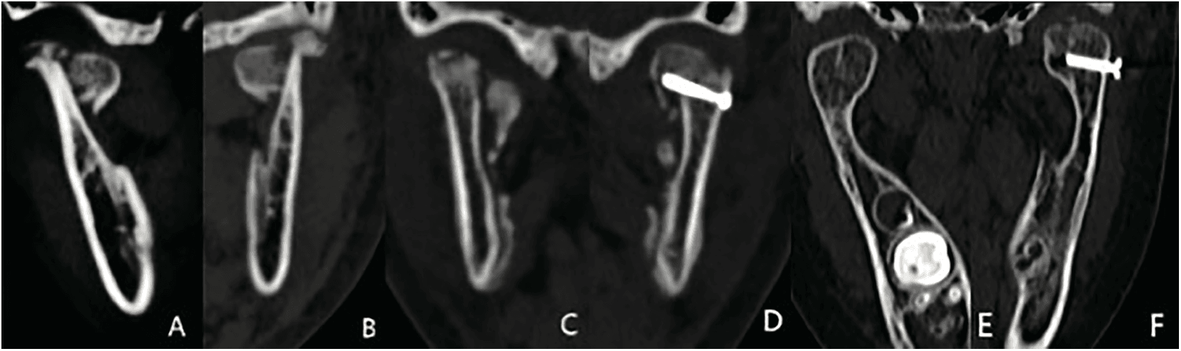 Figure 2. Mandibular computed tomography images before and after treatment. (A and B) CT images of the mandible following the traumatic injury, showing bilateral intracapsular condylar fractures, with the left condyle adhered to the lateral side of the articular fossa. (C and D) Changes in the left condyle after surgery, with the fractured end significantly reduced. The fracture fragment of the left condyle has shifted with absorption. (E and F) The condyle was in satisfactory shape after 10 months, with visible joint space.