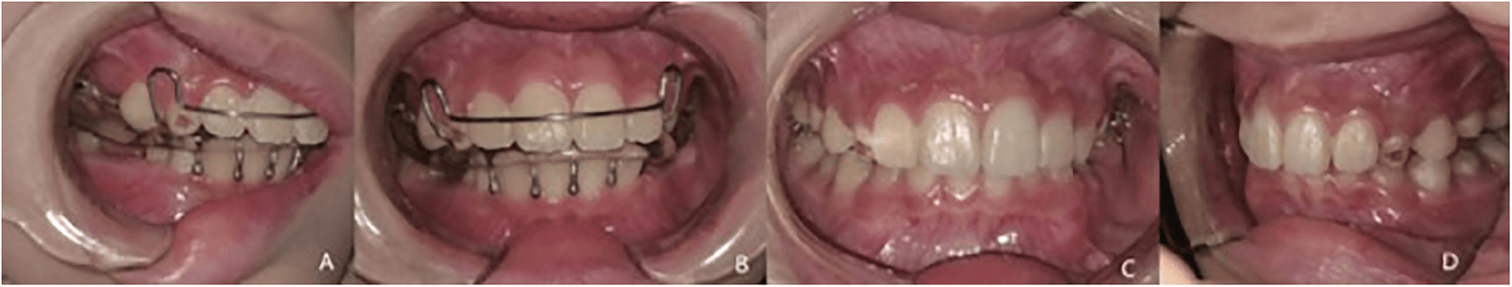 Figure 3. Twin block appliance retention and occlusal outcome. (A and B) The appliance demonstrated good retention during treatment; the bilateral molars were missing. (C and D) After treatment, the occlusal relationship was satisfactory, with significant improvements in both deep overbite and deep overjet.