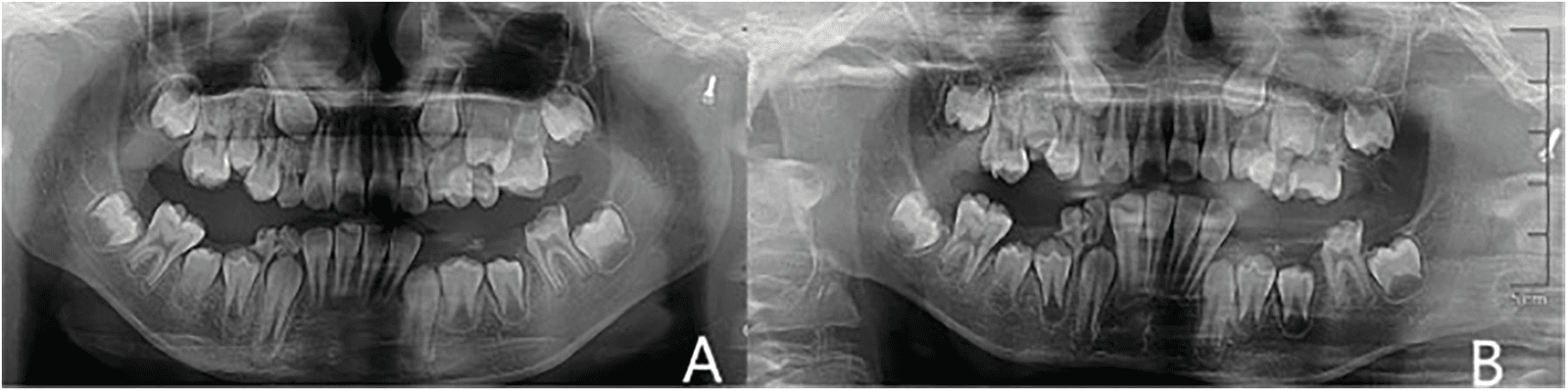Figure 4. Panoramic radiographs showing mandibular root healing and orthodontic potential A: Root tip trauma of the mandibular anterior teeth, missing deciduous molars, crown defect of 36, and left condylar implant. B: Four months after treatment, the shadow at the root tips of the mandibular anterior teeth had disappeared, indicating that orthodontic force can be achieved by relying on the mandibular anterior teeth.