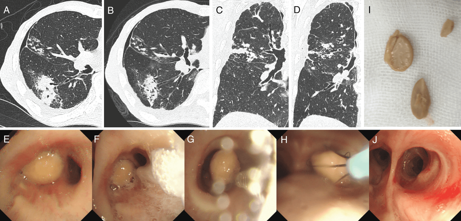 Figure 1. Chest computed tomography (CT) and bronchoscopic findings. (A) Axial and (C) coronal reconstruction CT on admission revealed granular shadows indicative of non-tuberculous mycobacteria in the middle lobe and consolidation attributed to bacterial pneumonia in the right lower lobe. (B) Axial and (D) coronal reconstruction CT demonstrated a new nodular shadow within the right lower lobe bronchus, prompting suspicion of an aspirated boiled soybean. (E) Flexible bronchoscopy revealed an obstructing boiled soybean surrounded by edema and redness. (F) Initially, a brush was used to create a gap, (G) followed by careful extraction using curettage, and (H) basket forceps. (I) The extracted boiled soybean was brittle and fragmented into three pieces. (J) Post-removal examination of the bronchus revealed no residual soybeans.