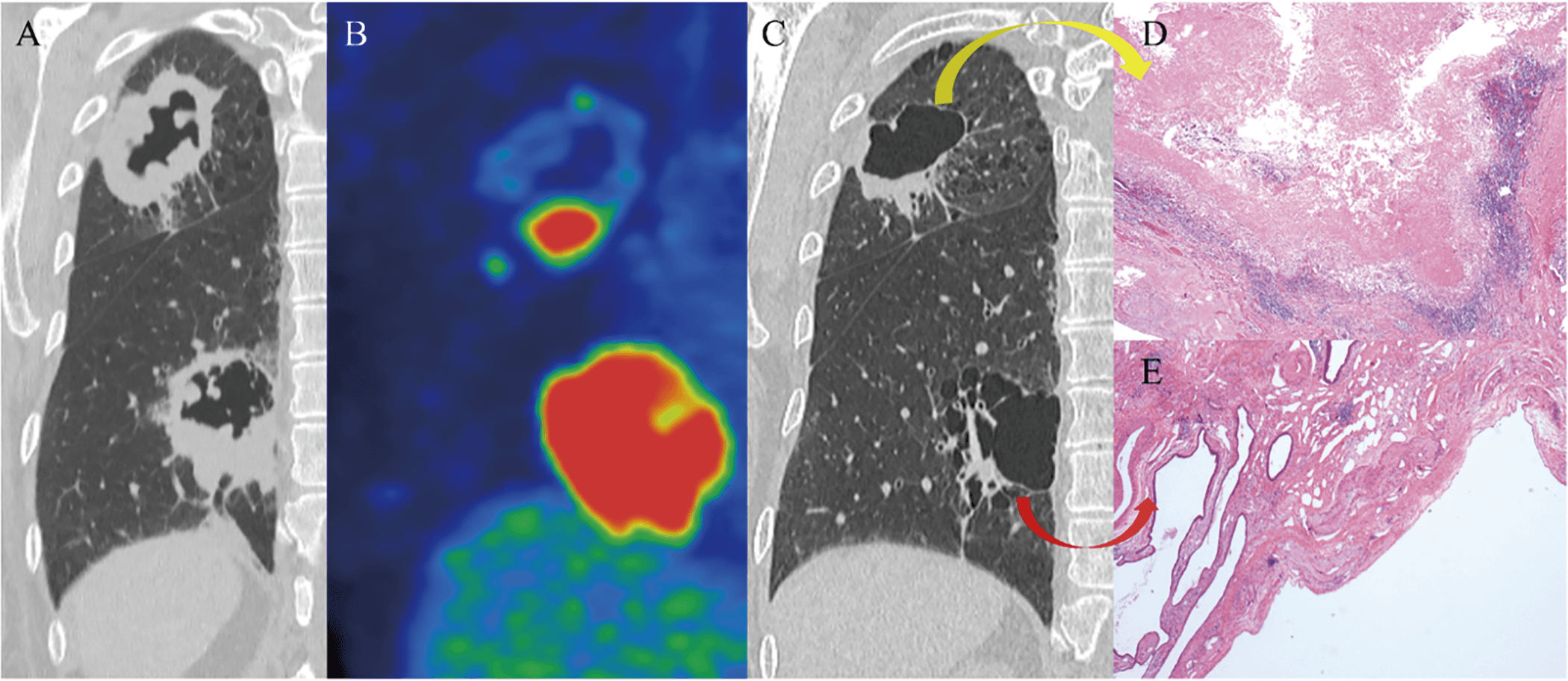 Figure 1. Simultaneous Diagnosis of Non-small Cell Lung Cancer and NTMLD. (A) Imaging detected an incidental cavitary mass in the right S2 and S6 regions. (B) Positron emission tomography/computed tomography revealed SUVmax values of 8.7 in S2 and 19 in S6. (C) Diagnosed with simultaneous cT4N0M0 stage IIIA non-small cell lung cancer (S6) and NTMLD (M. avium) (S2). After 3 months of treatment with carboplatin combined with nanoparticle albumin-bound paclitaxel, as well as rifampicin, ethambutol, clarithromycin, and amikacin, both tumors regressed. (D, E) The patient underwent right upper lobectomy and left S6 segmentectomy, achieving pathological complete remission.