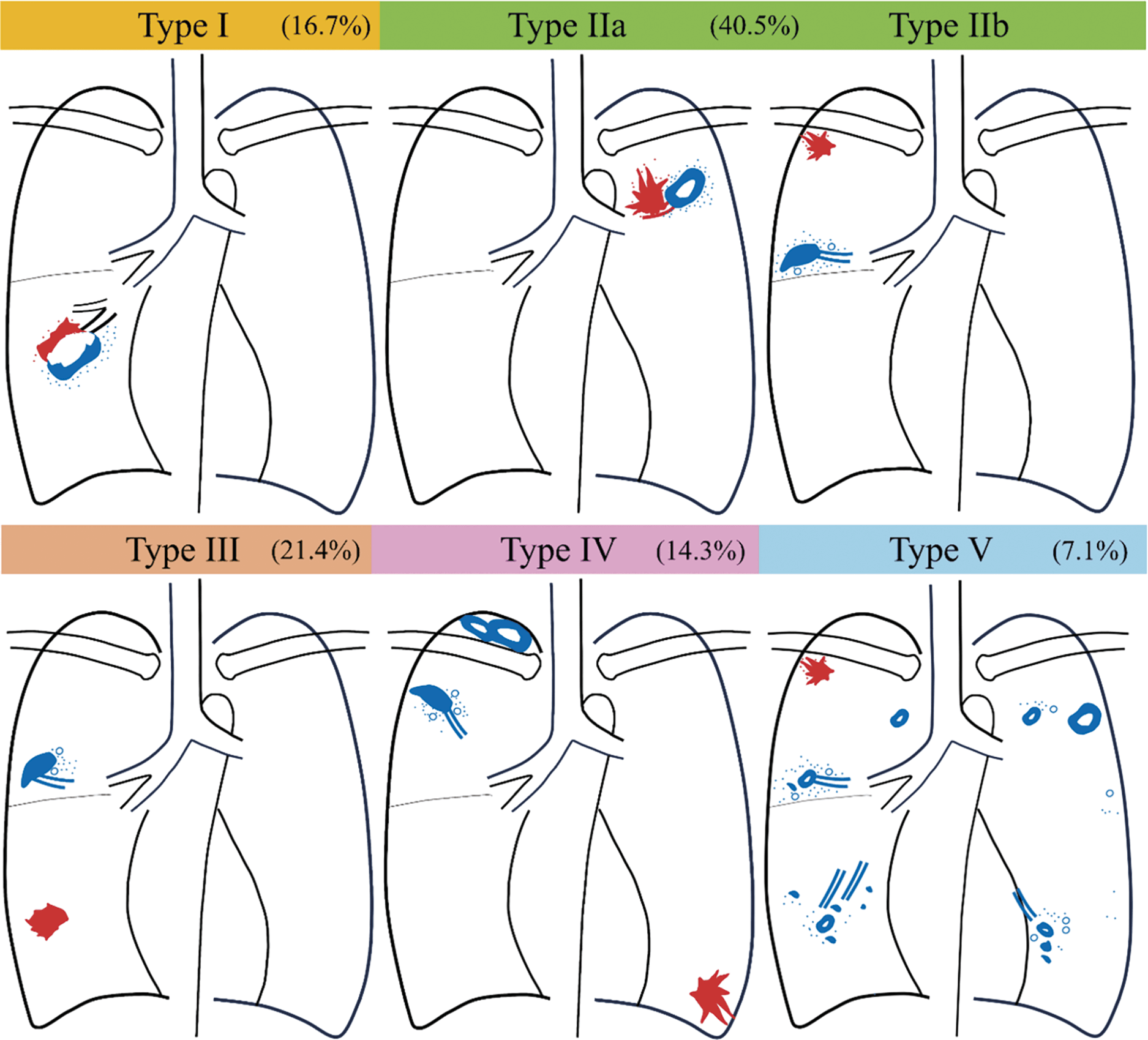 Figure 2. Classification of Lesion Distribution in Simultaneous Lung Cancer and NTMLD on Chest Imaging*. *Chest imaging, including computed tomography and plain radiography. Red lesions: Primary lung cancer; blue lesions: non-tuberculous mycobacterial lung disease; Type I: lung cancer and NTMLD present within the same lesion; Type II: both lesions located within the same lung lobe; IIa: adjacent lesions in the same lobe; IIb: nonadjacent lesions in the same lobe; Type III: lesions in different lobes of the same lung; Type IV: lesions present in the contralateral lung; Type V: unclassifiable due to random distribution or difficulty in lesion identification.