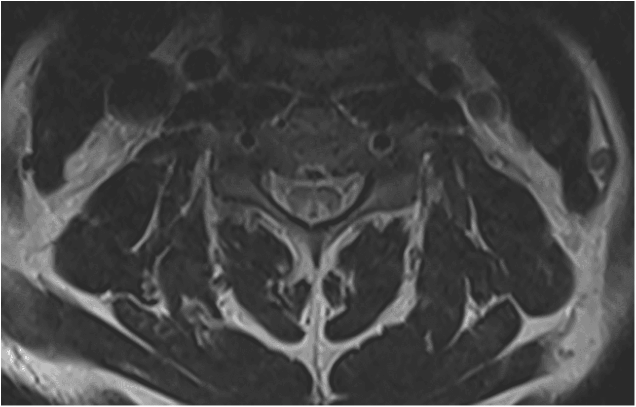 Figure 1. Magnetic resonance imaging of the cervical spine with a symmetric, bilateral, and high T2 signal in the dorsal columns, indicated by the characteristic inverted “V” or “bunny-ear” sign.