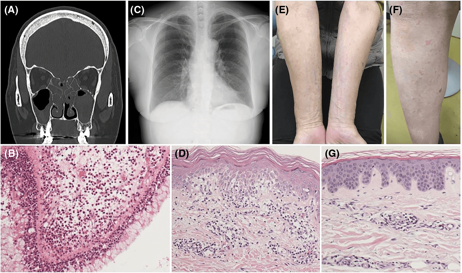 Figure 1. Clinical findings of the patient. (A) A coronal CT scan before endoscopic sinus surgery for eosinophilic chronic rhinosinusitis in year X-6 showed widespread mucosal thickening in all sinuses. (B) High-magnification biopsy of the right ethmoid sinus [hematoxylin and eosin (H&E) stain] revealed ciliated columnar epithelium with internal edema and significant eosinophil and lymphocyte infiltration. (C) A chest radiograph in year X-2 showed no infiltrative shadows. (D) High-magnification initial biopsy of the right thigh skin (H&E stain) revealed lymphocyte, eosinophil, and neutrophil infiltration around dermal capillaries without vasculitis. (E, F) Skin findings included mildly pruritic erythematous macules on the forearms (E) and lower legs (F). (G) A high-magnification second skin biopsy (H&E stain) of the left lower leg, taken during mepolizumab and prednisolone treatment, showed mild chronic inflammation in the superficial dermis, with predominantly neutrophils and a few eosinophils.