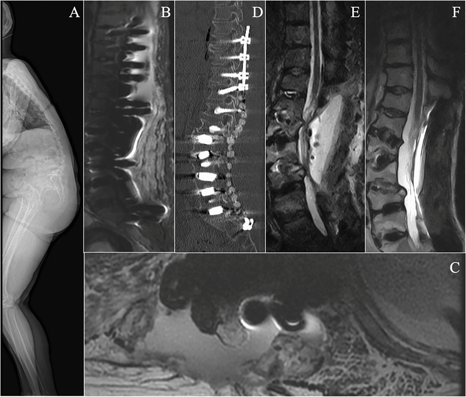 Figure 1. Imaging findings of the patient. (A) Preoperative standing full-body radiograph; (B and C) STIR sequence and T2-weighted MRI taken the day after the second debridement surgery; (D) sagittal CT showing cement beads in place; (E) MRI STIR sequence showing fluid signal at the surgical site before the final debridement surgery; and (F) T2-weighted MRI showing improvement at the infection site before discharge.