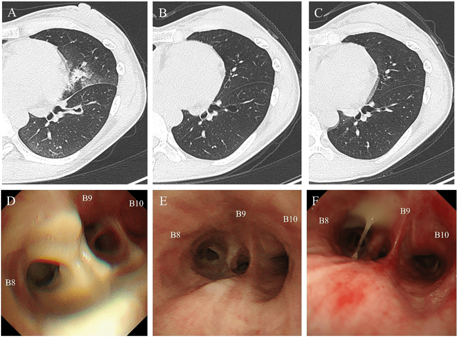Figure 2: Patient’s computed tomography and bronchoscopy images. (A) Diagnosis: CT shows bronchial wall thickening, bronchiectasis, consolidation, opacities, and upper lobe changes; (B) Six months: CT shows improvement in all parameters except bronchiectasis; (C) Three years: CT shows near-complete resolution; (D) Diagnosis: Bronchoscopy shows necrotic tissue and purulent mucus in the left B8 bronchus; (E) Six months: Bronchoscopy shows resolved necrosis and bronchial scarring; (F) Three years: Bronchoscopy shows improved scarring; purulent sputum persists.