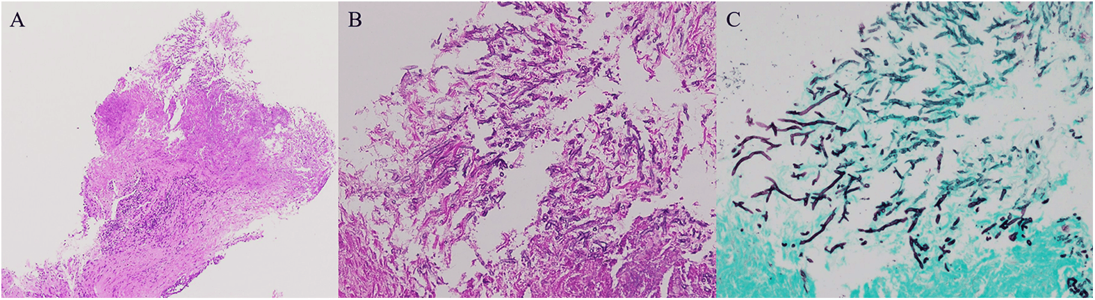 Figure 3: Patient’s pathological findings. Hematoxylin and eosin staining revealed necrotic material with inflammatory cell infiltration (A, ×40; B, ×200). The Grocott-stained specimen (C, ×200) demonstrates fungal hyphae with consistent width and black.