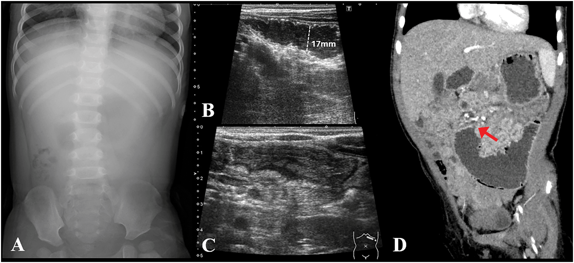 Figure 2. Imaging findings of the patient. (A) Abdominal radiograph taken on day 9. (B, C) Abdominal ultrasound performed on day 10. (D) Computed tomography scan of the abdomen on day 11.