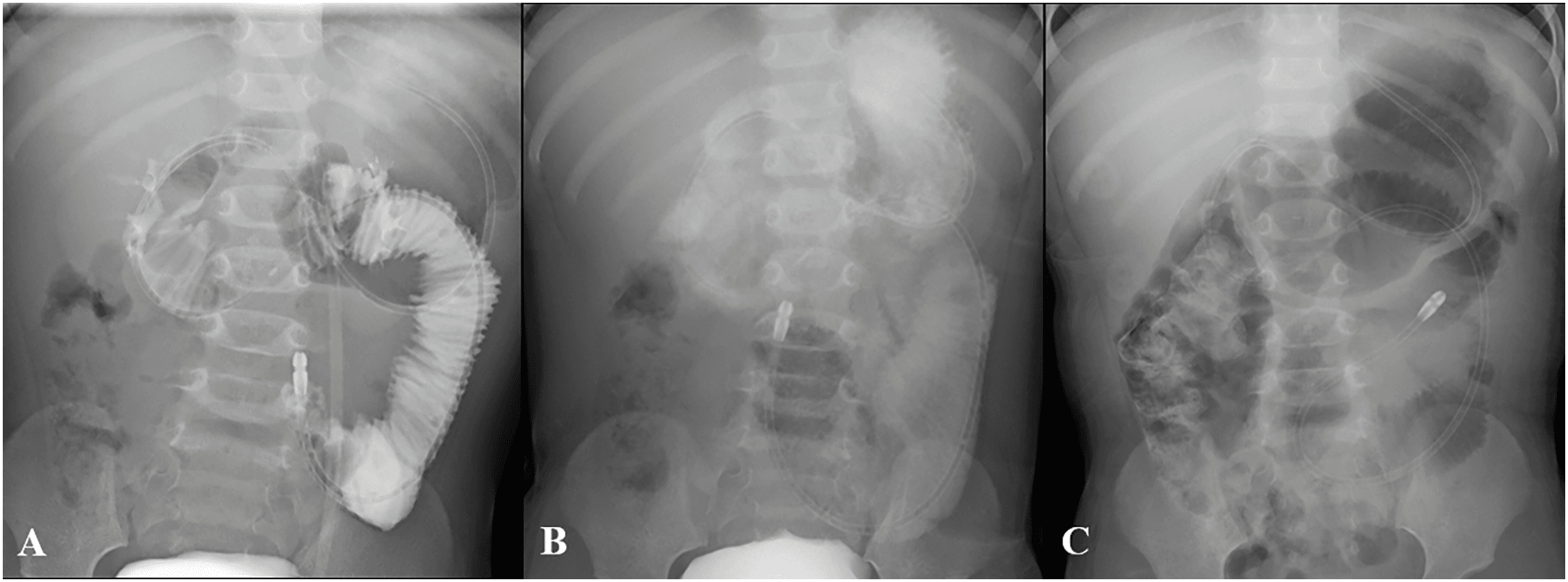 Figure 3. Contrast study findings following elemental diet tube placement. (A) Abdominal radiograph confirming the successful placement of the elemental diet tube. The contrast study showed no flow of contrast medium beyond the dilated intestinal segment. (B) Follow-up X-ray revealed that the contrast medium had reached the distal intestine 3 hours later. (C) Follow-up X-ray the day after the administration of the elemental diet tube.