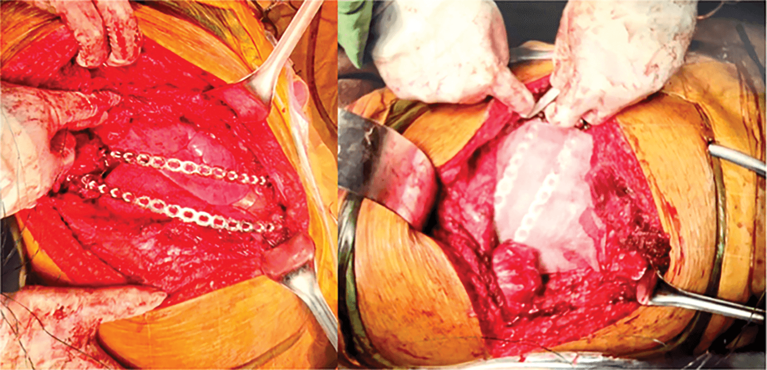 Figure 3. Intraoperative chest wall reconstruction.
