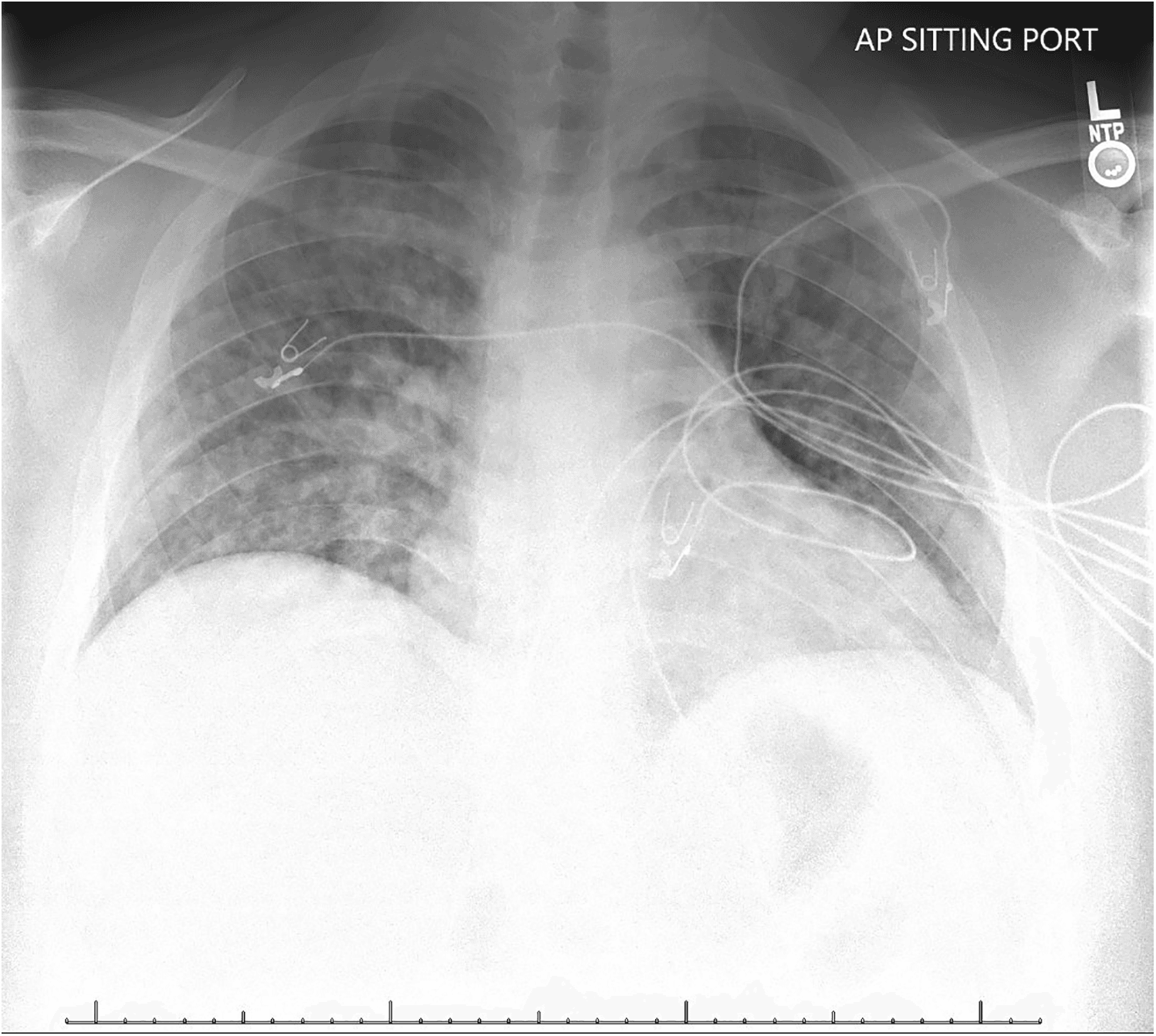 Figure 1. Chest X-ray image.