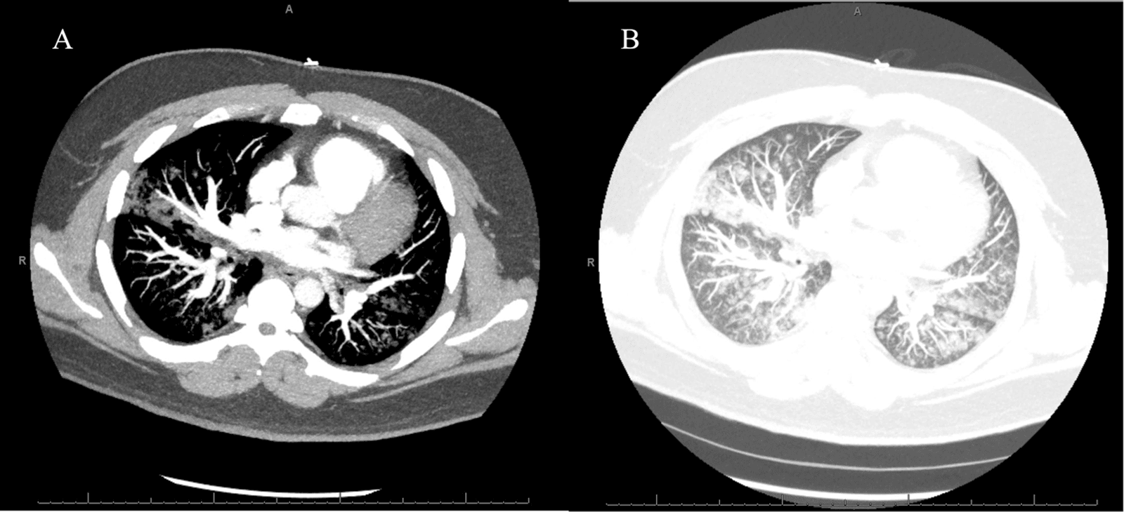 Figure 2. Computed tomography of the chest with contrast of axial view. (A) Soft tissue window and (B) lung window.