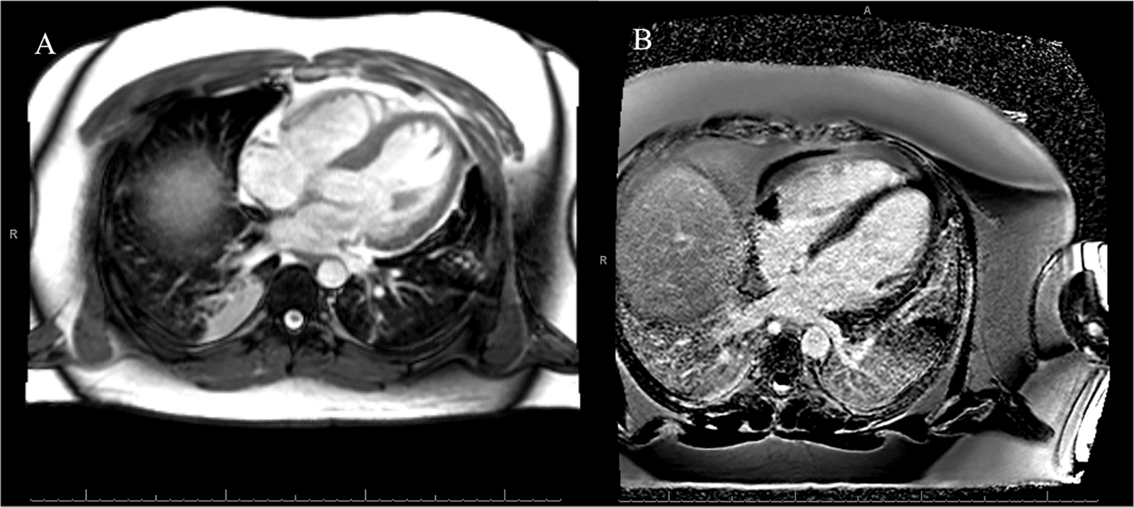 Figure 3. Cardiac magnetic resonance imaging findings in the myocardial wall. (A) T2-weighted and (B) T1-weighted post-contrast.