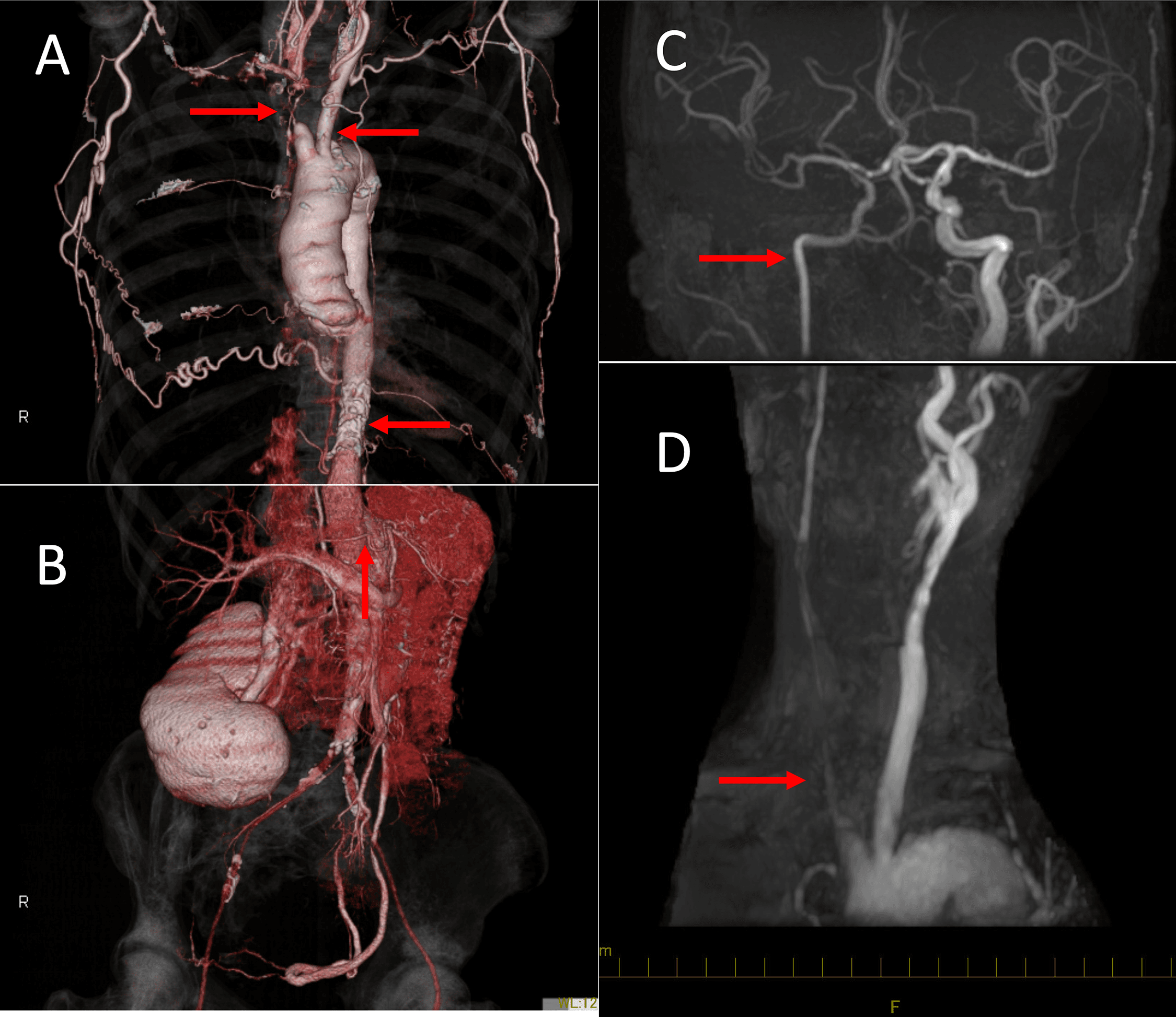 Figure 1. Preoperative imaging of arterial conditions. (A) Occlusion of the brachiocephalic artery, both subclavian arteries, and the origin of the celiac axis; (B) stenosis of the superior mesenteric artery; (C) stenosis of the left internal carotid artery; (D) occlusion of the right common carotid artery.