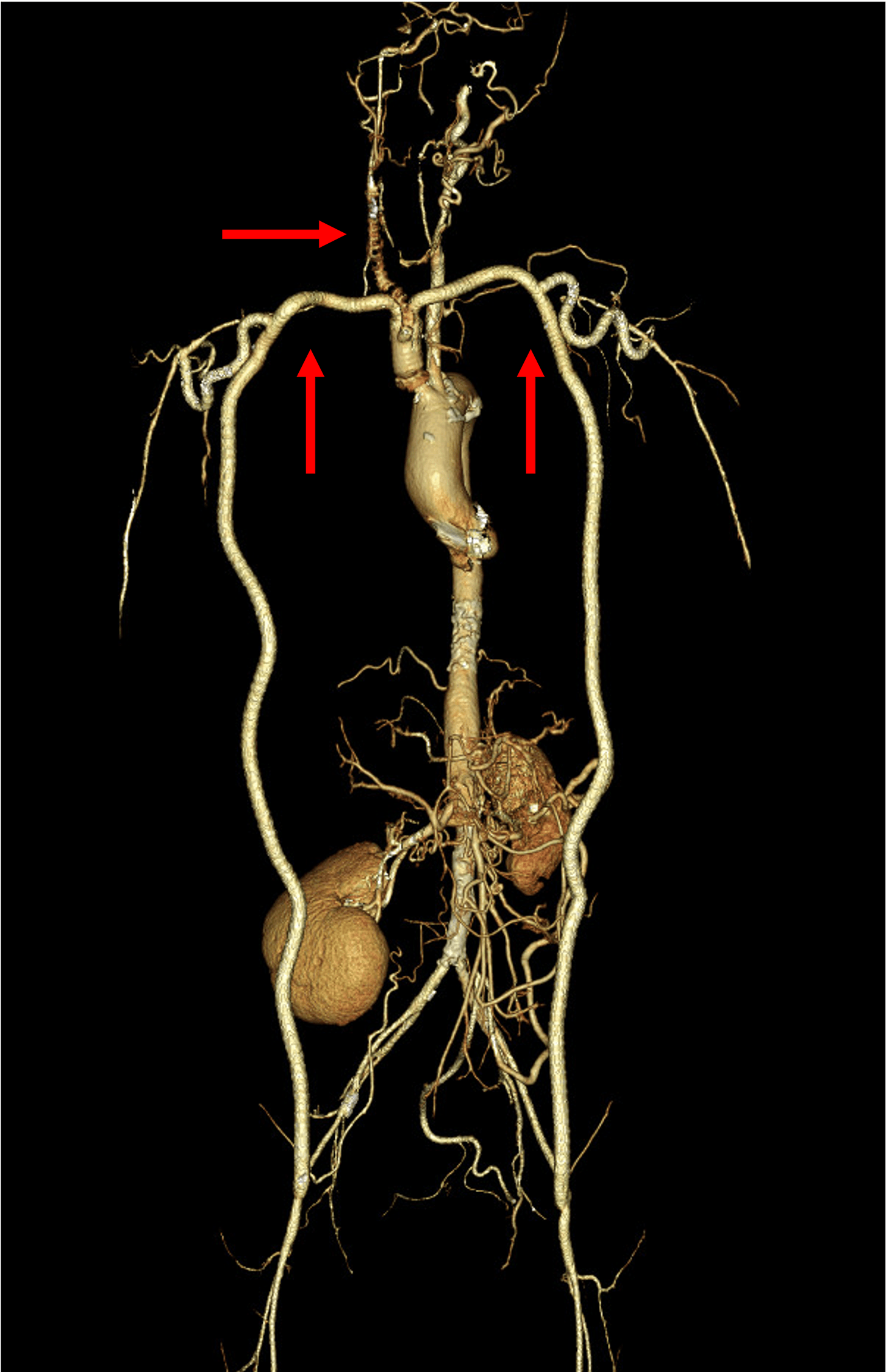 Figure 2. All bypass grafts were patent except for the right carotid artery graft.