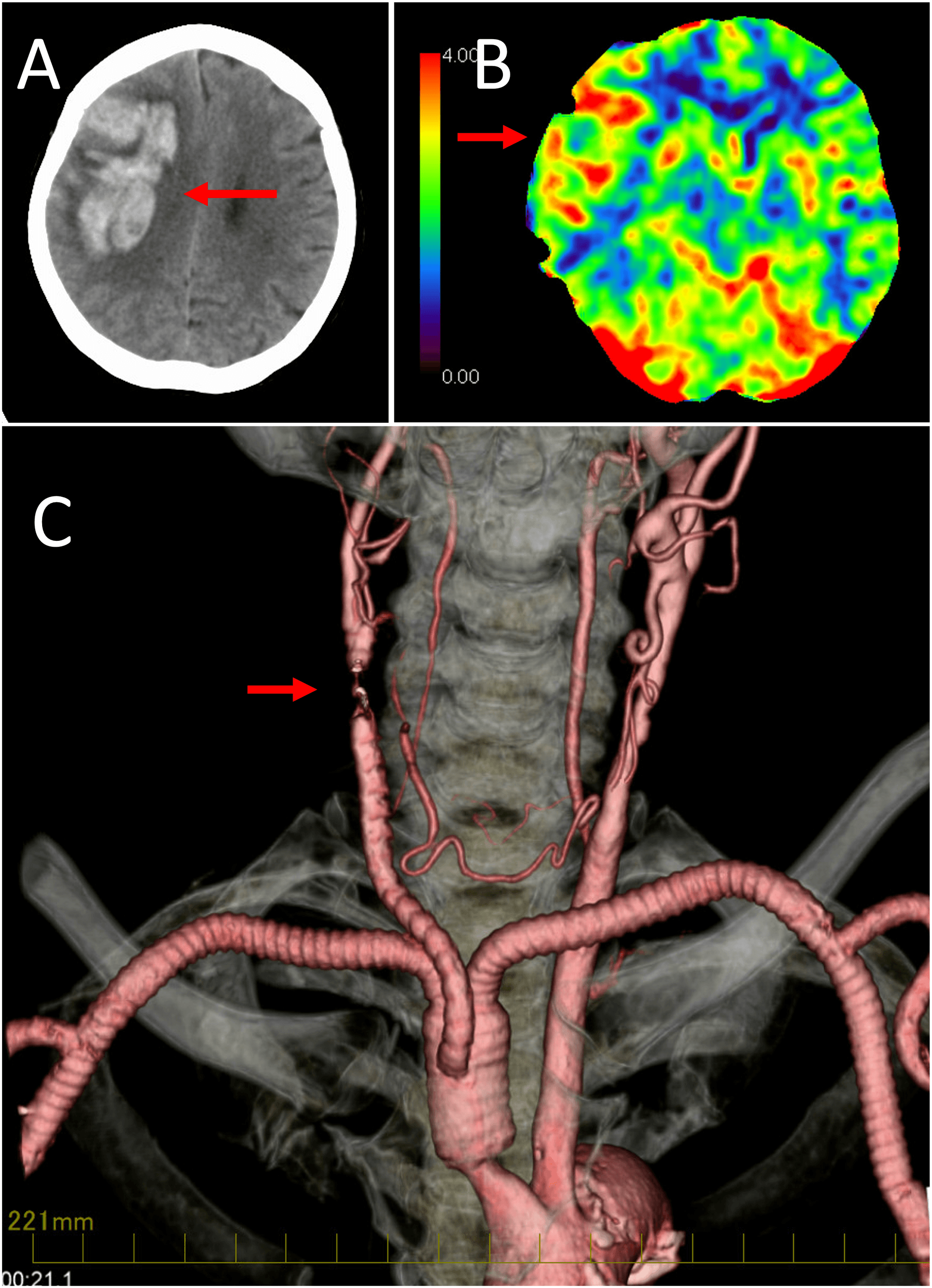 Figure 3. Changes in brain blood flow after bypass surgery. (A) Right cerebral hemorrhage; (B) hyperperfusion of the right brain after bypass surgery; (C) reduction of bypass graft flow.
