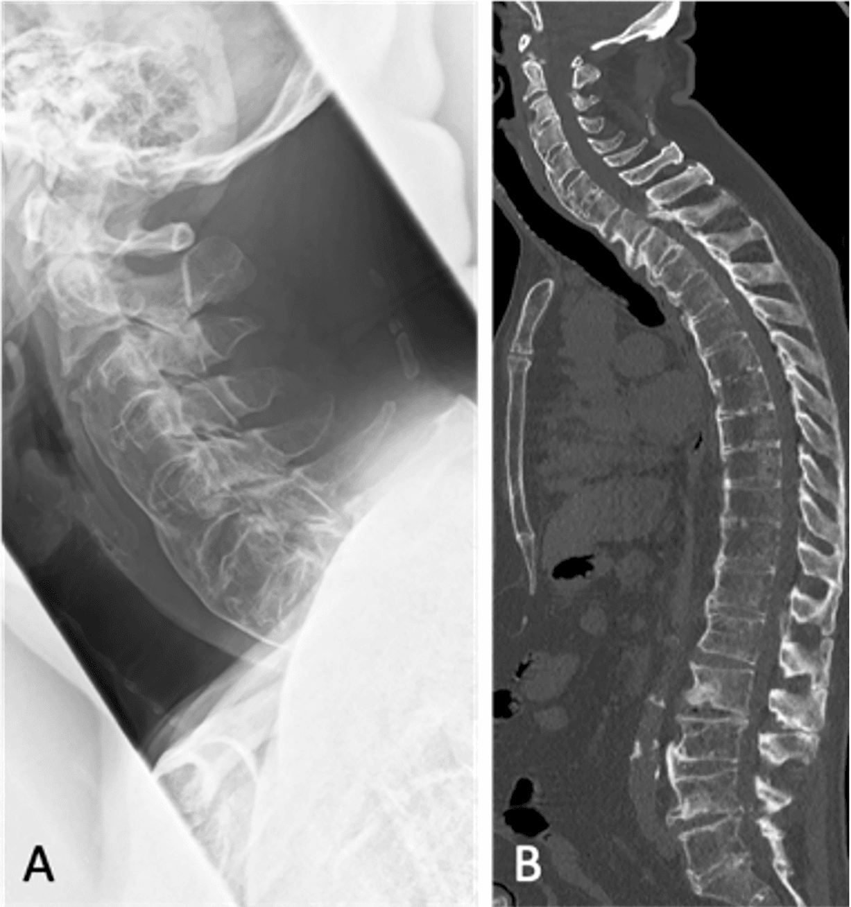 Figure 1. Preoperative imaging of OLF and diffuse idiopathic skeletal hyperostosis. (A) Lateral cervical spine X-ray and (B) whole-spine CT scan. CT, computed tomography; OLF, ossification of the ligamentum flavum.
