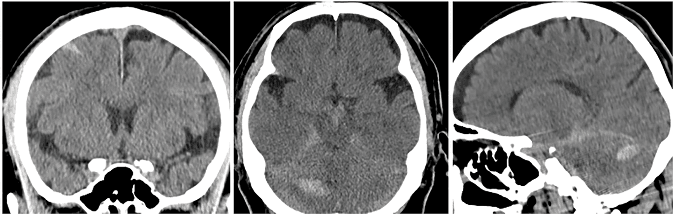 Figure 2. Postoperative cerebellar hemorrhage. Brain CT demonstrating a right cerebellar linear hemorrhage and subarachnoid hemorrhage following acute CSF loss. CSF, cerebrospinal fluid; CT, computed tomography.