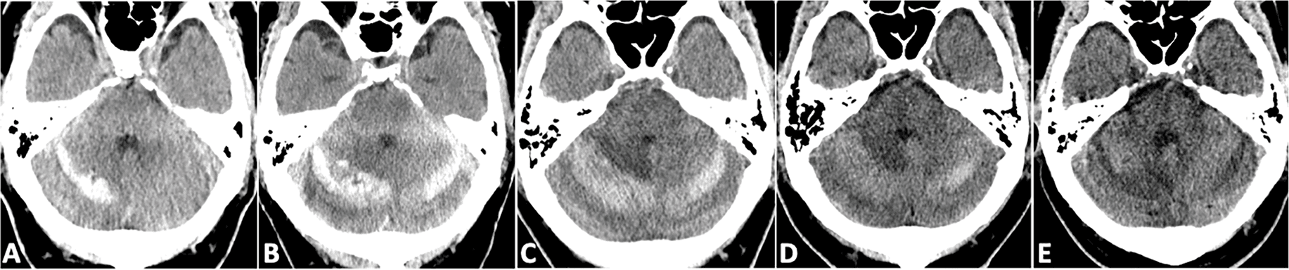 Figure 3. Serial brain CT changes of cerebellar hemorrhage. (A) POD 1: Increased right cerebellar hemorrhage; (B) POD 3: Bilateral cerebellar hemorrhages; (C) POD 7: No further hemorrhagic progression; (D) POD 10: Partial resolution of hemorrhages; (E) POD 34: Complete resolution of cerebellar hemorrhages. CT, computed tomography; POD, postoperative day.