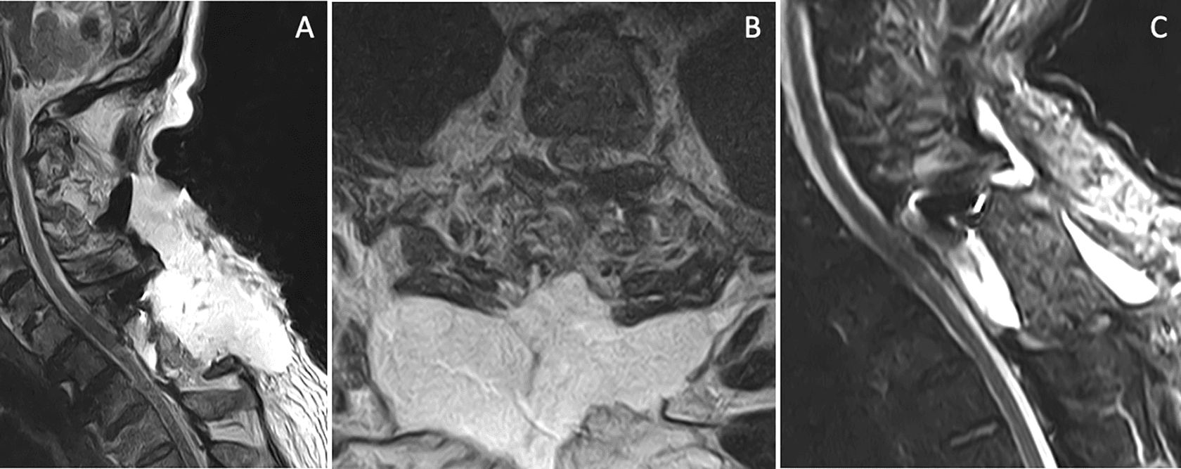 Figure 4. CSF leakage and post-repair outcome. (A, B) MRI showing subcutaneous CSF accumulation and persistent leakage before repair; (C) POD 34 MRI confirming complete resolution of CSF leakage. CSF, cerebrospinal fluid; MRI, magnetic resonance imaging; POD, postoperative day.