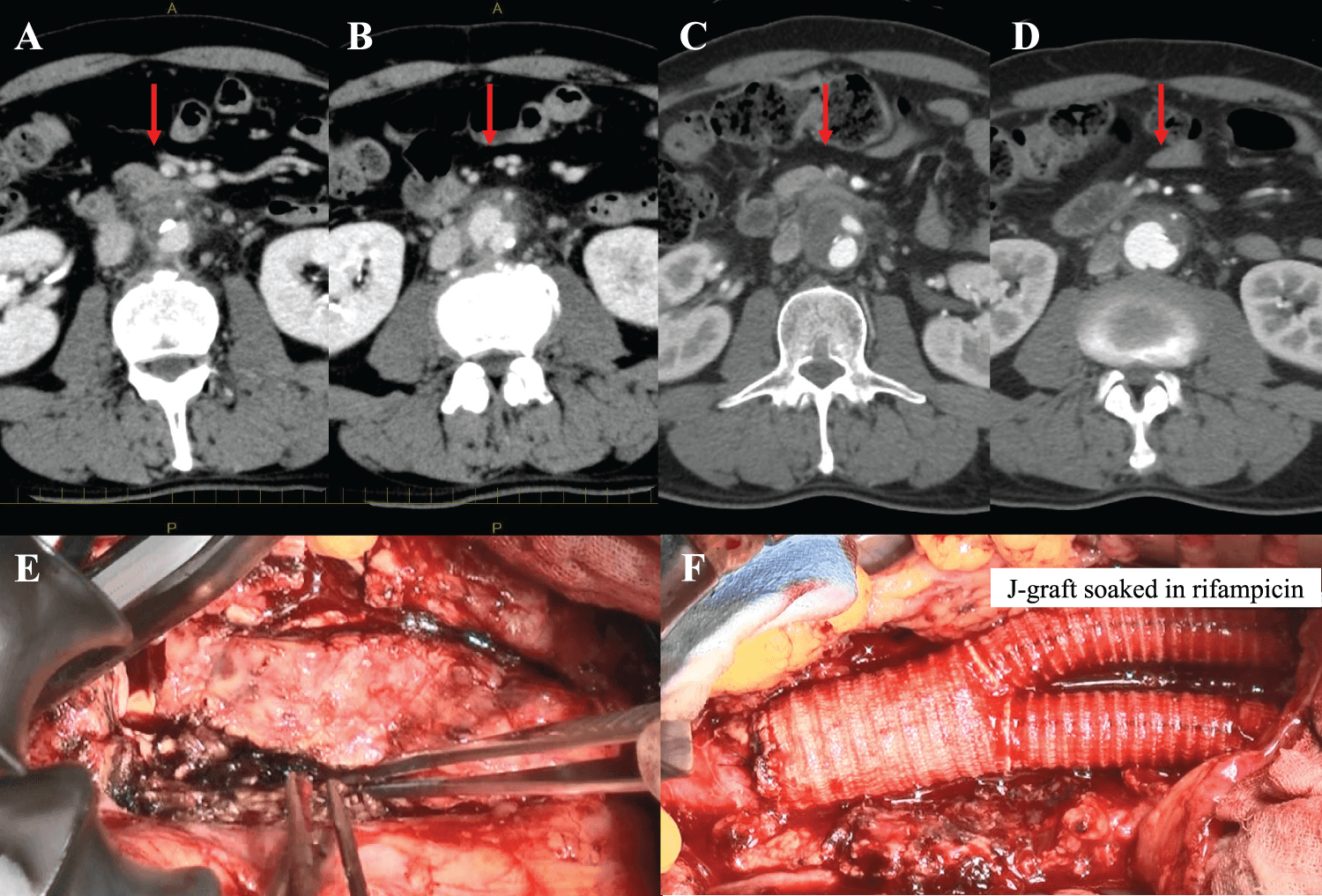 Figure 1. Infected abdominal aortic aneurysm with rupture. (A, B) Contrast-enhanced computed tomography (CT) showed a 25-mm abdominal aortic aneurysm with an irregular shape. (C, D) Follow-up CT after 2 weeks of antibiotic therapy showed enlargement of the aneurysm to 30 mm with suspected rupture into the inferior vena cava. (E, F) Intraoperative findings showed Y-graft replacement with aneurysm resection and omental implantation.