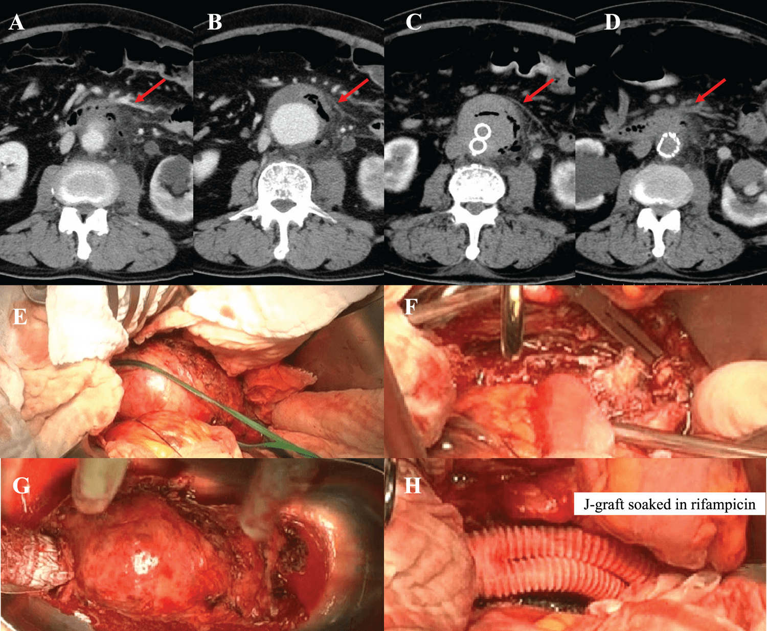 Figure 2. Infected abdominal aortic aneurysm treated with endovascular aneurysm repair (EVAR) and open repair. (A, B) Contrast-enhanced computed tomography (CT) showed a 64 × 58-mm infrarenal abdominal aortic aneurysm with intramural air. (C, D) Post-EVAR imaging showed successful exclusion of the aneurysm. (E–H) Intraoperative findings showed Y-graft replacement and omental implantation using a rifampicin-soaked graft.
