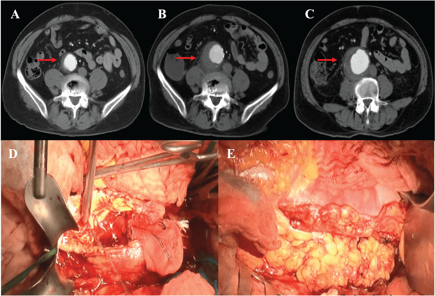 Figure 3. Acute enlargement of infected abdominal aortic aneurysm. (A–C) Contrast-enhanced computed tomography (CT) showed rapid enlargement of the abdominal aortic aneurysm from 31 to 62 mm with marked aortic wall enhancement. (D, E) Operative findings showed Y-graft replacement with aneurysm resection and omental implantation using a pyoctanine-treated graft.