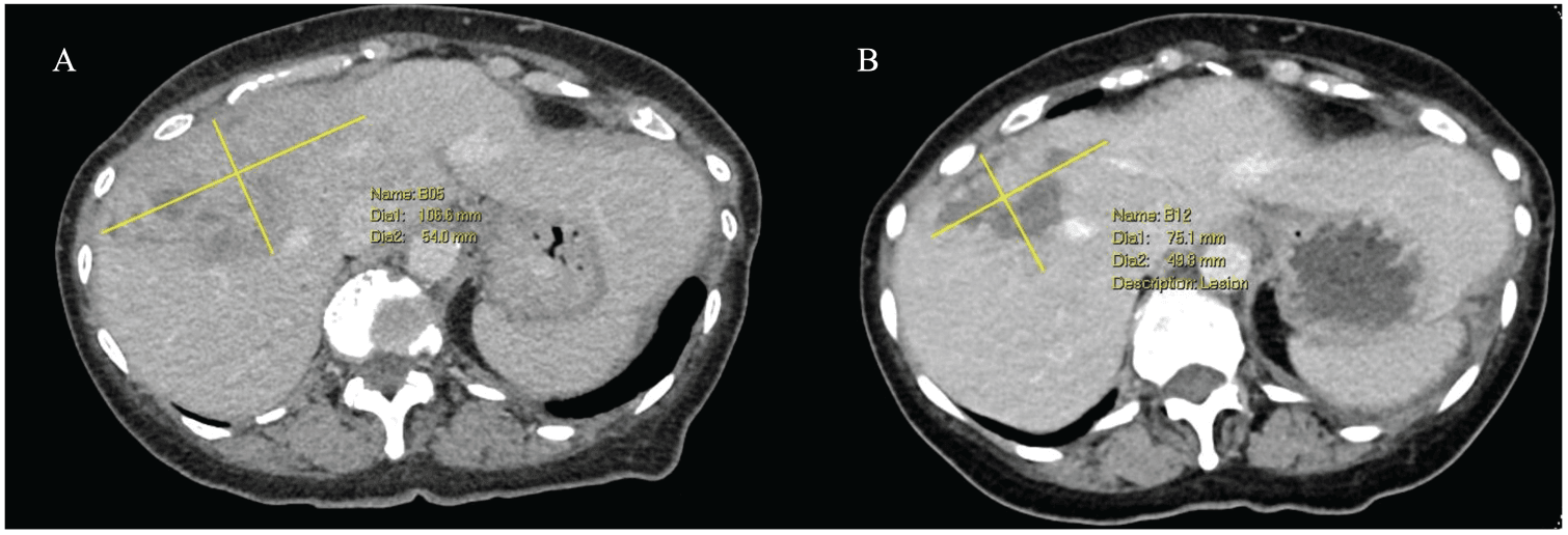 Figure 2. Liver computed tomography images obtained before and after fulvestrant plus capivasertib. (A) January 24, 2025; (B) February 22, 2025.