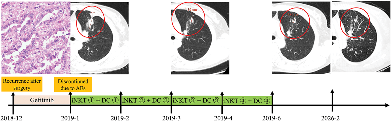 Figure 1. Clinical course and outcomes of the patient after allogeneic iNKT cell immunotherapy.