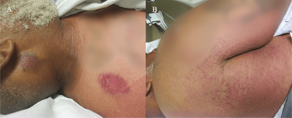 Figure 1. Pressure-related skin changes after suspected fentanyl-contaminated cocaine overdose (A) Right shoulder and neck swelling with patchy erythema; (B) back pressure-related erythema and skin changes.