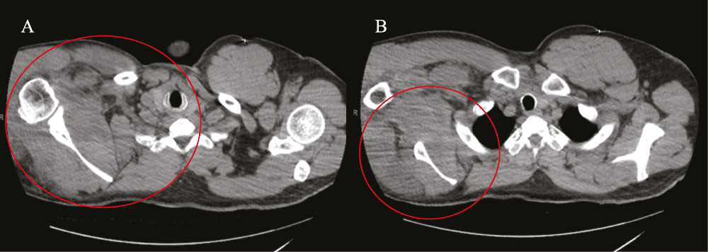 Figure 3. CT findings of pressure-related soft tissue injury (A) Right shoulder soft tissue and intramuscular edema; (B) upper back soft tissue and intramuscular edema.