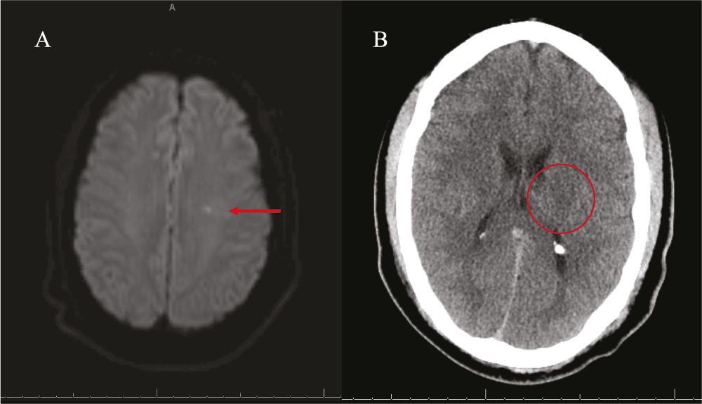 Figure 4. MRI and CT findings of acute small-vessel infarct (A) Magnetic resonance imaging shows a small acute infarct; (B) computed tomography shows subtle corresponding hypodensity.